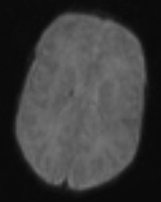 hemosid2_result