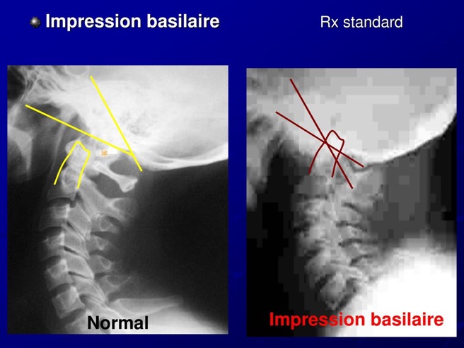 Impression+basilaire+Rx+standard