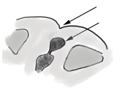 cicatrice