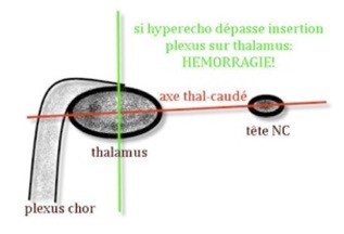 hemor3