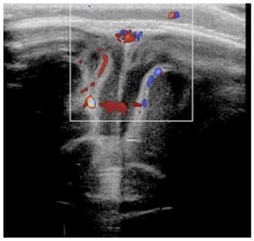 meningite1