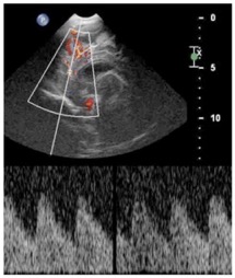 meningite2