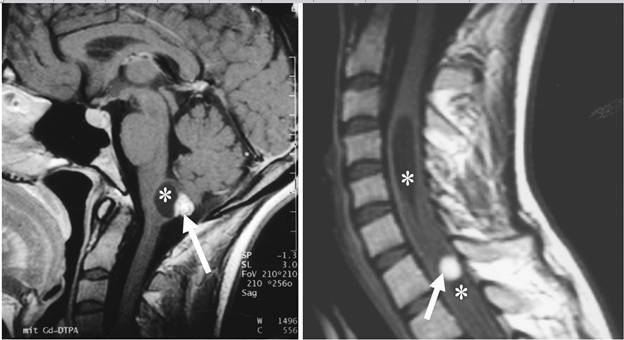 adrenal_von-hippel-lindau-syndrome-Image001