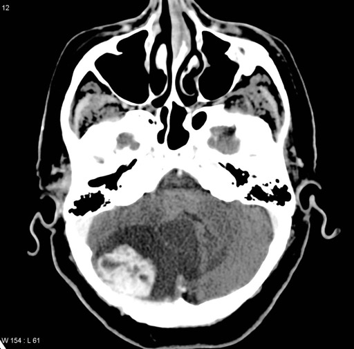 hemangioblastoma-von-hippel-lindau-syndrome