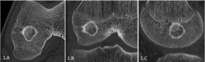 BLosteoblastome1