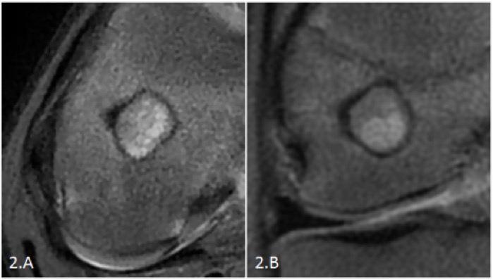 BLosteoblastome2