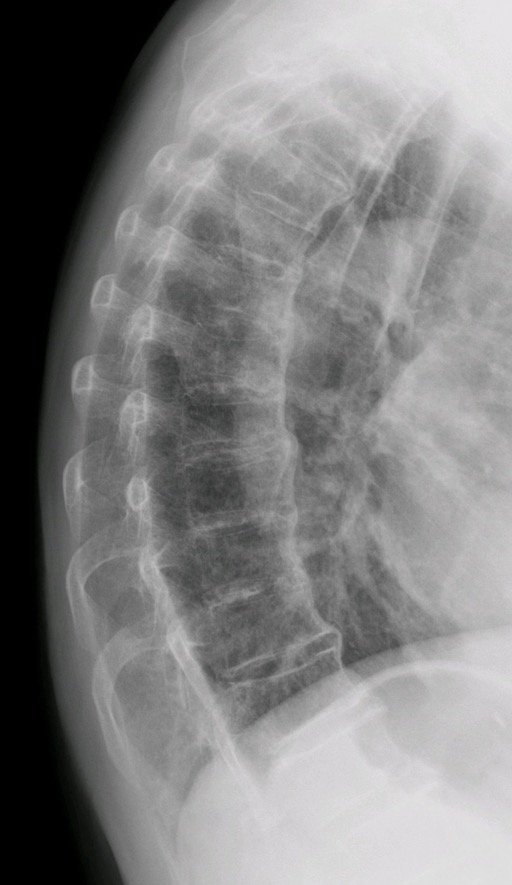 Forestier&#39;s_disease,_X-ray_of_thoracic_column