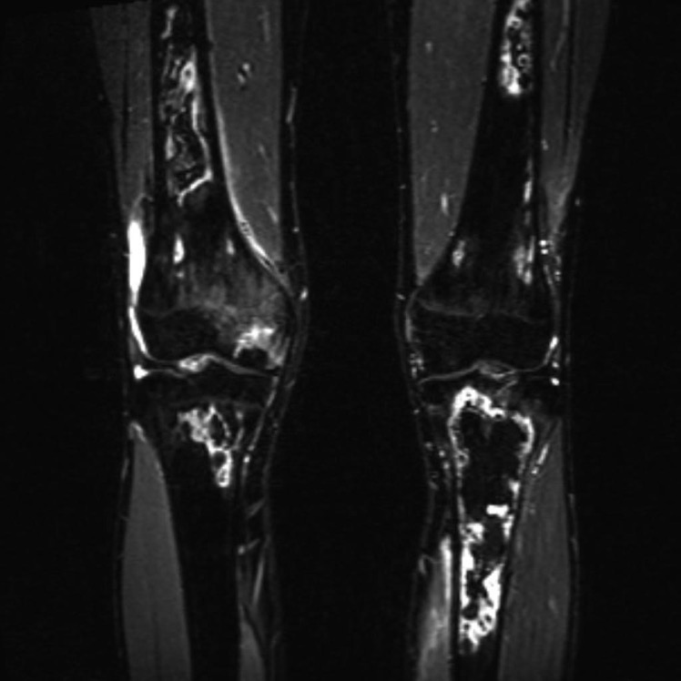 bone-infarcts-1