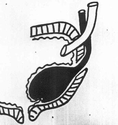 uropathies11-9a667