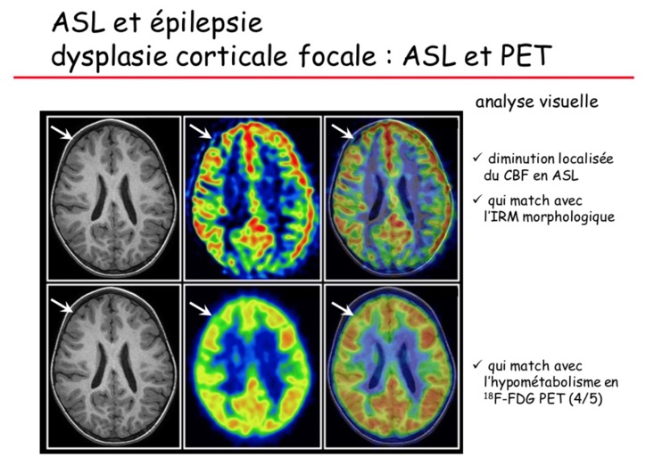 ASL et épilepsie