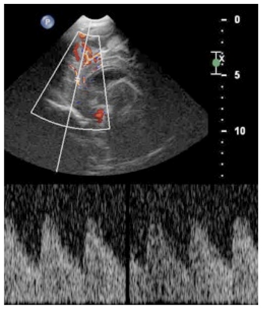 meningite2