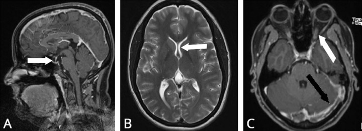 MRI-Befunde-bei-IIH