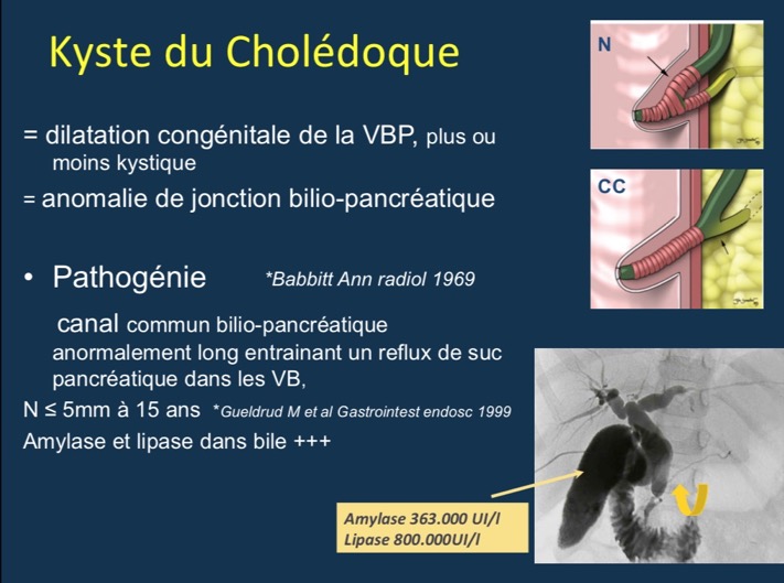 Kyste du Cholédoque