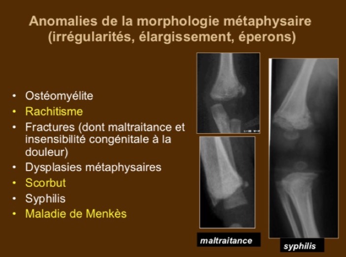 Anomalies de la morphologie métaphysaire