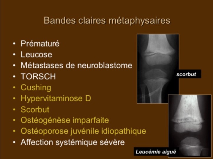 Bandes claires métaphysaires