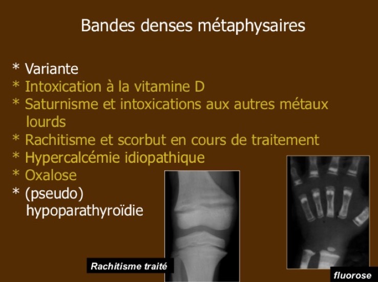 Bandes denses métaphysaires