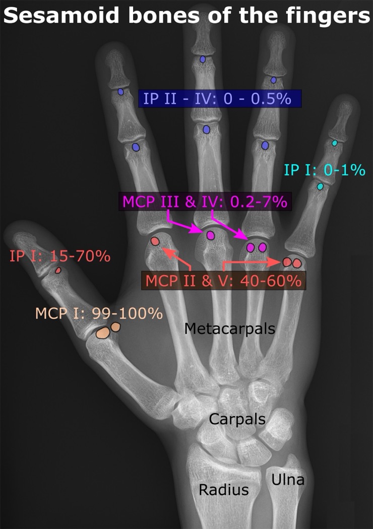 Sesamoid_bones_of_the_fingers