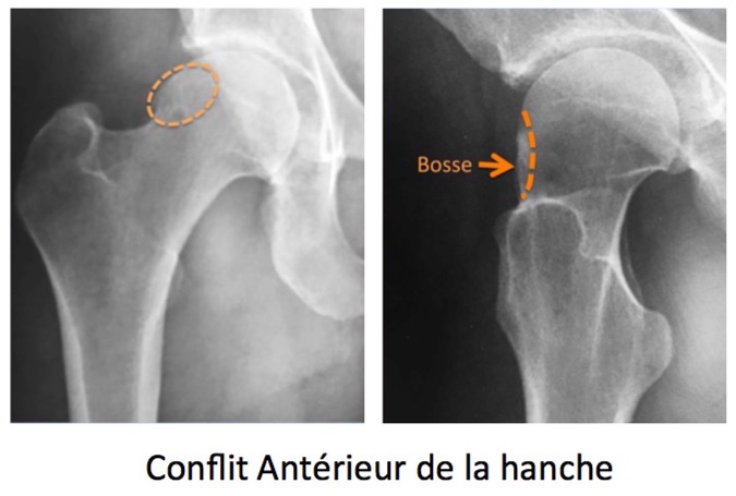 Conflit-antérieur-de-la-hanche