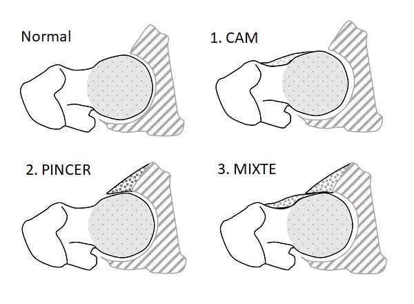syndrome-femoro-acetabulaire