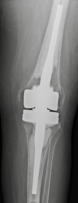 prothese-charniere-genou-docteur-simian