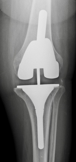prothese-genou-lcck-docteur-simian