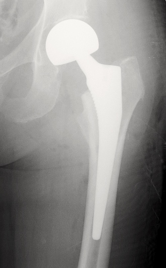 prothese-intermediaire-hanche-pih