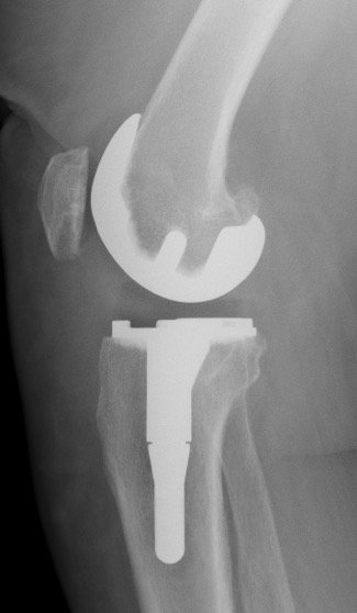 prothese-quille-tibia-orthopedie