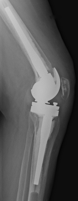 radio-ptg-charniere-profil-chirurgie-orthopedique