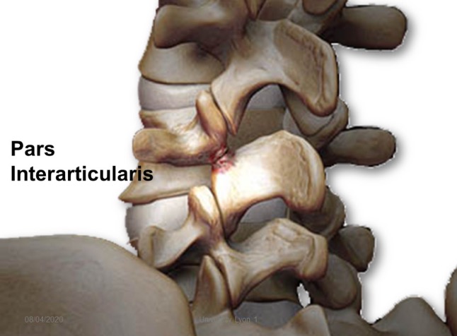 spondylolyse2