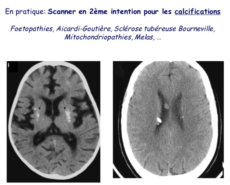 calcifications SNC