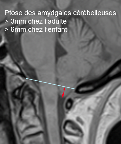 Mesure ptose amygdales