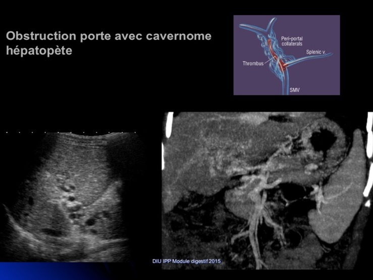 cavernome portal